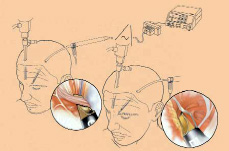 神經(jīng)科手術(shù)圖片